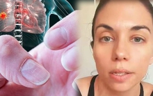 Người phụ nữ 35 tuổi mất 2 năm mới biết mình bị ung thư phổi vì các triệu chứng bị nhầm lẫn là do căng thẳng