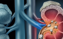 Thói quen tưởng vô hại nhưng lại là nguyên nhân khiến thận chứa cả "túi sỏi"