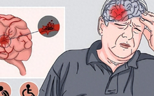 3 THỰC PHẨM ăn càng ít càng tốt nếu không muốn bị cao huyết áp, xuất huyết não, nhồi máu cơ tim