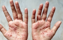 Việt Nam xuất hiện 2 ca đậu mùa khỉ chưa rõ nguồn lây, làm 6 điều để phòng bệnh