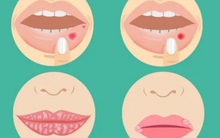 4 dấu hiệu bệnh nghiêm trọng có thể xuất hiện ở môi: Nếu thấy cần đi khám ngay