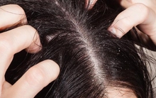 Ngứa da dầu, người đàn ông qua đời sau 3 tháng: 4 cơn ngứa cảnh báo bệnh nặng hoặc ung thư