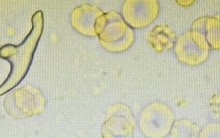 Đau ngực, khó thở, người đàn ông đi khám và phát hiện 'thủ phạm' bất ngờ trong phổi