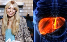 Chuyên gia chỉ 'đích danh' 8 dấu hiệu gan đang quá tải, cần dừng rượu bia ngay