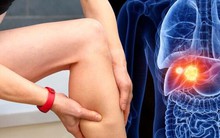 Khi gan suy hỏng, chân sẽ phát ra 5 dấu hiệu cảnh báo, có 1 cũng nên đi khám ngay