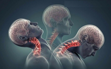 Người phụ nữ 34 tuổi dán mắt vào điện thoại hơn 4 giờ/ngày, cơ thể chịu dày vò không tưởng, cứ thức dậy là đau đớn