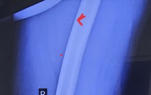 Bác sĩ 'nổi da gà' khi nhìn ảnh X-quang của nam bệnh nhân, cảnh báo nguy cơ từ món ăn nhiều người mê