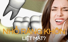 Bác sĩ tiết lộ sự thật chuyện "nhổ răng khôn bị méo miệng, liệt mặt"