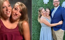 Cặp song sinh dính liền nổi tiếng nhất thế giới: Dùng chung một cơ thể suốt 34 năm, cuộc sống hiện tại gây kinh ngạc