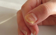 Người thiếu sắt nhìn vào móng tay thấy ngay 3 điểm, hãy mau tự kiểm tra