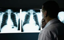 Số người mắc bệnh ung thư có thể lên đến 35 triệu vào năm 2050