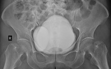 Phát hiện 2 bàng quang qua CT ổ bụng khi đi khám viêm hô hấp