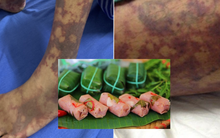 Mắc viêm màng não do liên cầu lợn vì "mê" nem chua, thịt lợn tái