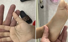 Nhìn lòng bàn tay của bé gái 2 tuổi uống khoảng 2000-2500 ml sữa tươi mỗi ngày khiến nhiều người xót xa