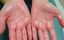 Trời nóng dễ đổ mồ hôi nhưng bác sĩ nhắc nhở 7 kiểu này là bệnh, gồm cả ung thư