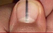 Móng tay xuất hiện sọc đen có phải ung thư da?