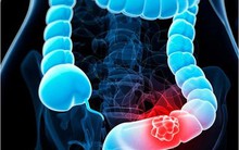 Mắc ung thư giai đoạn 4 ở tuổi 37, nữ bác sĩ cảnh báo 2 dấu hiệu dù nhẹ cũng không được bỏ qua