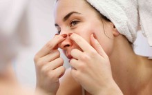 Đừng bao giờ nặn mụn ở vùng này trên mặt vì có thể gây nhiễm trùng "chết người"