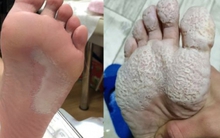 Bàn chân chàng trai lở loét trắng xóa, bốc mùi cá thối vì 1 hành vi khi đi giày rất nhiều người mắc phải