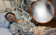 Một thói quen khiến phổi người phụ nữ trắng xoá, suy giảm 60% chức năng phổi và vĩnh viễn không thể phục hồi