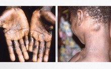 Chủng virus 'chết chóc' hơn của đậu mùa khỉ đang gây lo ngại