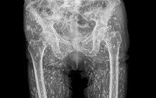 Xem ảnh chụp X-quang thấy hông bệnh nhân chi chít đốm trắng, bác sĩ nói không nên ăn loại thịt lợn này