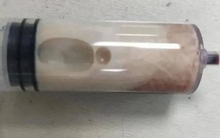 Thanh niên nhập viện sau bữa lẩu nướng, bác sĩ rút ra thứ chất lỏng khiến ai cũng rùng mình