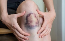 Người có 4 thứ này trên da dễ có "cả đống" tế bào ung thư trong người mà chưa biết