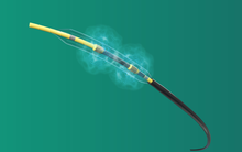 Ứng dụng công nghệ phá vôi lòng mạch mới điều trị hẹp mạch vành phức tạp