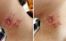 Bé trai 10 tuổi bỗng xuất hiện những nốt mẩn lạ trên da nhưng vẫn chưa tìm ra được nguyên nhân