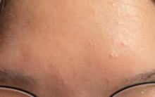 Con gái mọc mụn trứng cá, mẹ xin nghỉ phép đưa con đi cấp cứu