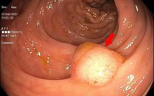 20 tuổi đã suýt bị ung thư đại tràng: Bác sĩ nói người trẻ có 4 dấu hiệu này khi đi vệ sinh phải đi khám gấp