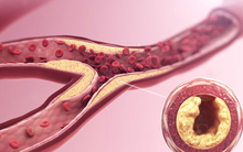 3 "kẻ thù" giấu mặt đang âm thầm bóp nghẹt mạch máu mỗi ngày, đột quỵ dễ ập đến bất ngờ