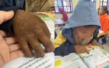 Hình ảnh bàn tay nứt nẻ của cậu bé 8 tuổi vùng cao khiến triệu người nghẹn lại