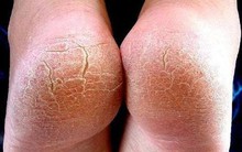 Đừng bỏ qua: 5 dấu hiệu ở bàn chân cảnh báo sức khỏe có vấn đề!