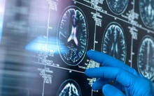 Cô gái 30 tuổi kinh hoàng phát hiện giun kí sinh trong não, không ngờ món ăn này lại là nguyên nhân