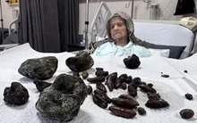 Hãi hùng hình ảnh 63 “hòn đá” được lấy ra từ bụng bà lão 92 tuổi, nguyên nhân đến từ một thói quen sai lầm khi ăn uống