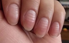 6 thay đổi ở móng tay có thể cảnh báo bệnh tật, thậm chí là ung thư