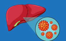 4 dấu hiệu ở miệng cảnh báo gan của bạn đang gặp vấn đề