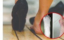 1 dấu hiệu ở bàn chân cảnh báo bệnh lý: Tiếc là chưa nhiều người quan tâm