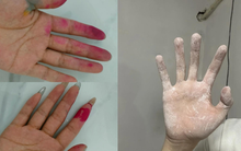 Khuyên thật: Khi làm 7 việc này nhất định phải đeo găng tay, nếu không thì "rước bệnh vào người"