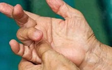 4 thay đổi ở ngón tay có thể là dấu hiệu ung thư phổi, hãy đi khám ngay!