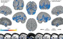 Quét não của 30 phi hành gia bằng MRI trước và sau khi bay vào vũ trụ, các chuyên gia có phát hiện sốc