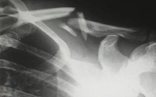 Dùng kem chống nắng quá mức, người phụ nữ bị gãy xương