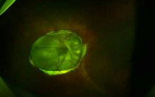 Lạ lùng người phụ nữ "mọc hoa" trong mắt suýt bị mù, bác sĩ phát hiện điều "đáng sợ"