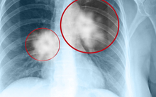 Vợ chồng lần lượt mắc ung thư phổi khiến bác sĩ bàng hoàng: "Rốt cuộc chuyện gì đã xảy ra trong nhà này?"