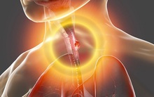 Thói quen ăn uống tưởng chừng vô hại âm thầm phá hủy tế bào, gia tăng nguy cơ ung thư thực quản