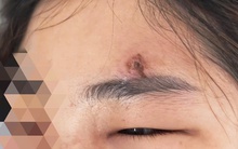 Nặn mụn trứng cá, nữ bệnh nhân nhập viện nguy kịch
