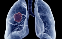 Mắc ung thư giai đoạn cuối, người đàn ông kiên trì làm 1 việc khiến khối u thu nhỏ 50%, bác sĩ ‘vỡ òa’