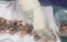 Thấy thứ được lấy ra từ 2 quả thận của bệnh nhân, bác sĩ thốt lên: ‘Sức chịu đựng quá phi thường’